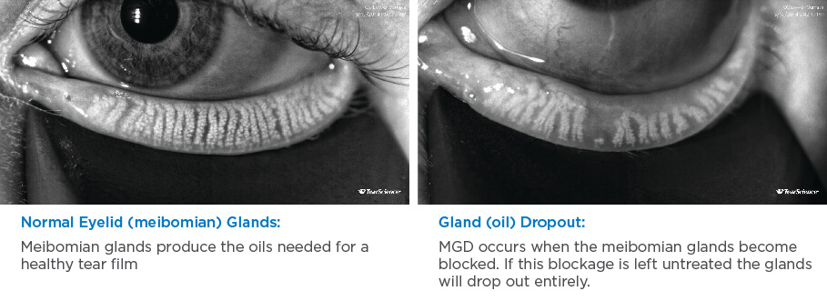 Detect Meibomian Gland Dysfunction Mgd Using Image Pr 